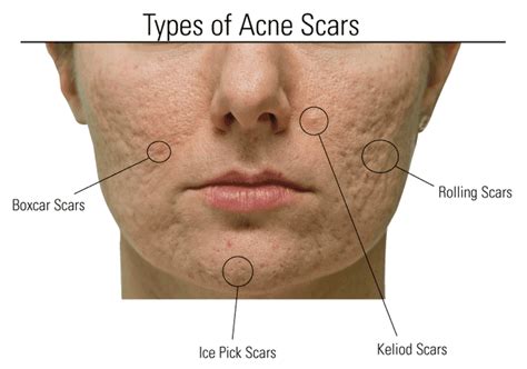 Acne and Acne Scars .